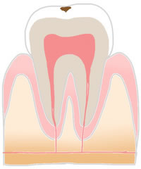 むし歯治療