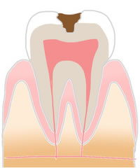 むし歯治療