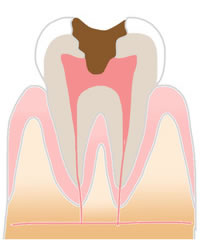 むし歯治療