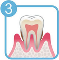 歯周病