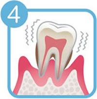 歯周病